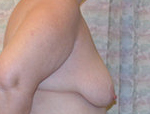 Patient # 24109 Before Photo # 3