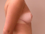 Patient # 85993 After Photo # 4