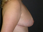 Patient # 68174 After Photo # 4