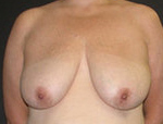 Patient # 68174 Before Photo # 1