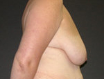 Patient # 68174 Before Photo # 3