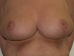 Patient # 43146 After Photo # 2