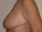Patient # 43146 After Photo # 4