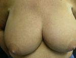 Patient # 43146 Before Photo # 1