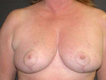 Patient # 67715 After Photo # 2