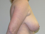 Patient # 67715 Before Photo # 3