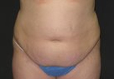 Patient # 88357 Before Photo # 1