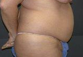 Patient # 76640 Before Photo # 3