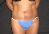 Patient # 48041 Before Photo # 1
