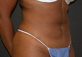 Patient # 86135 After Photo # 4