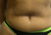 Patient # 86135 Before Photo # 1