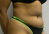 Patient # 86135 Before Photo # 3