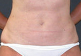 Patient # 26189 After Photo # 2