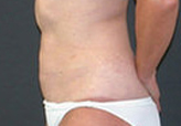 Patient # 26189 After Photo # 4