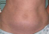Patient # 26189 Before Photo # 1