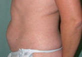 Patient # 26189 Before Photo # 3