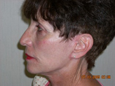 Patient # 55938 After Photo # 4