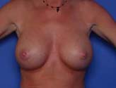 Patient # 75827 After Photo # 2