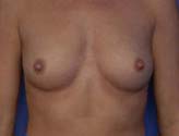 Patient # 75827 Before Photo # 1