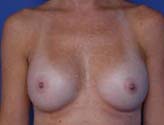 Patient # 19042 After Photo # 2