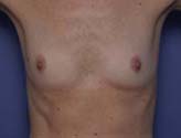 Patient # 19042 Before Photo # 1