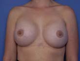 Patient # 52980 After Photo # 2