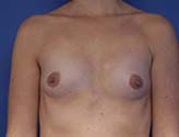 Patient # 52980 Before Photo # 1