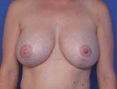 Patient # 93695 After Photo # 2
