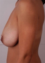 Patient # 52938 Before Photo # 1