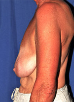 Patient # 87509 Before Photo # 1