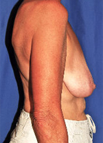 Patient # 87509 Before Photo # 3