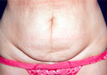 Patient # 53210 Before Photo # 1