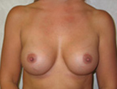 Patient # 31943 After Photo # 2