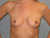 Patient # 31943 Before Photo # 1