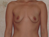 Patient # 19052 Before Photo # 1