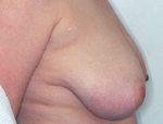 Patient # 94583 Before Photo # 3