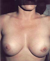 Patient # 58756 After Photo # 2