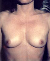 Patient # 58756 Before Photo # 1