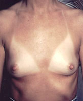 Patient # 58451 Before Photo # 1