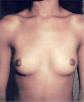 Patient # 43735 Before Photo # 1