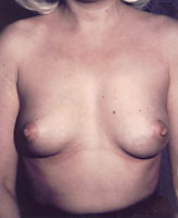 Patient # 72093 Before Photo # 1