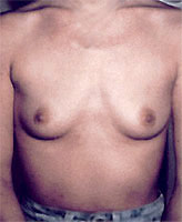 Patient # 20860 Before Photo # 1