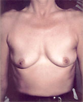 Patient # 89298 Before Photo # 1