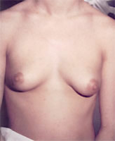 Patient # 47080 Before Photo # 1