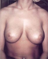 Patient # 47080 After Photo # 2