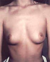 Patient # 10586 Before Photo # 1