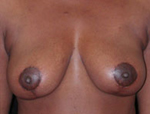 Patient # 66644 After Photo # 2