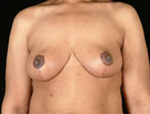 Patient # 34903 After Photo # 2