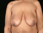 Patient # 34903 Before Photo # 1