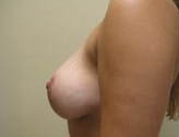 Patient # 20548 After Photo # 6